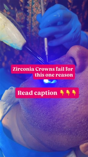 Dr. Vartika on Instagram: "Most zirconia crowns don’t fail because of the material. They fail because of what happens before and during cementation. In my clinical experience, the most common reason for zirconia crown failure is improper bonding protocol. Zirconia is not glass ceramic-it doesn’t etch with hydrofluoric acid like E-max. When it’s treated the same way, the bond is weak from day one. Zirconia needs proper surface conditioning: sandblasting with alumina, thorough cleaning, and the us