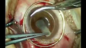 6.7K views · 155 reactions | Corneal transplant surgery. Septic | Fractured Reality | Facebook