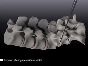 Posterior lumbar interbody fusion (PLIF) at L4-5