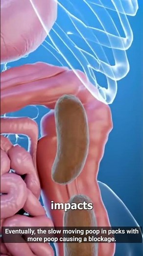What happens in constipation 3D animation | #3danimation