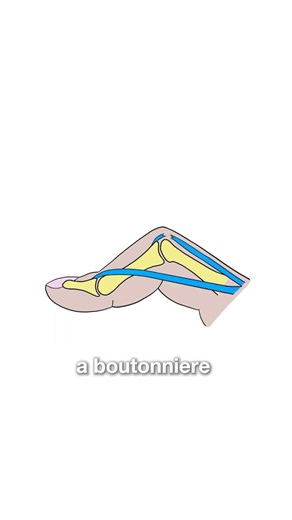 Boutonnière Deformity Explained