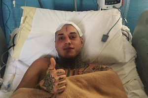 Meningioma benigno, cos’è il tumore che si sviluppa dalle meningi e quali sono i sintomi