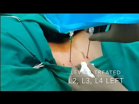 Cooled RF ablation - Lumbar Sympathetic chain