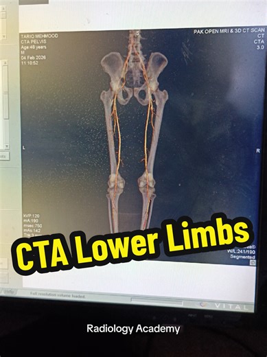 3D Reconstruction of CTA Lower Limbs in Radiology