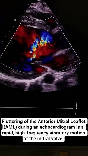 Fluttering of the Anterior Mitral Leaflet (AML) during echocardiogram 🫀#rheumatic #heartdisease