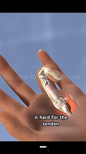 Trigger Finger! #triggerfinger #short #viral