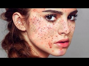 Pimple Popper & Blackhead Removal | Best Pimple Popping Compilation 2024 Video 9