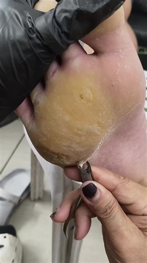 Complete Process to Remove Calluses Safely