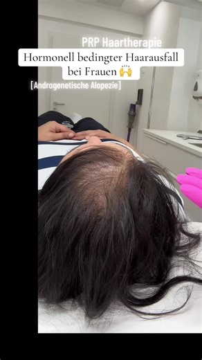 PRP Haartherapie gegen Haarausfall