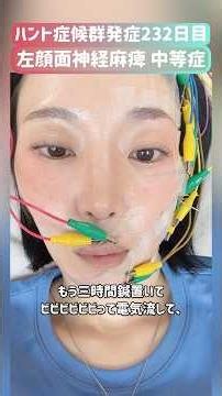 【発症232日目】病的共同運動をなくせる鍼灸院で治療を受けたよ！1回目 #ハント症候群 #顔面神経麻痺 #闘病中 #回復期 #鍼灸