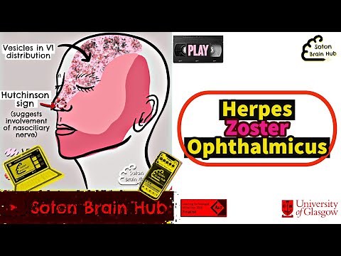 Herpes Zoster Ophthalmicus