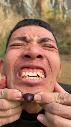 How I Cured a Bug Bite with Yogurt in the Wild Survival Hacks p4358