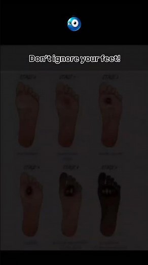 Stages of Diabetic Foot Ulcer 🚨 | Don’t Ignore the Early Signs!"