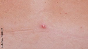 Young girl shows pimples on her skin on her back and shoulders. Beautician removes pimples on her skin