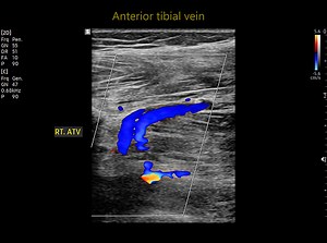Color Doppler ultrasound determination in deep vein thrombosis...
