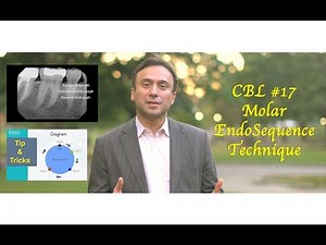 CBL #17 Molar with the EndoSequence Technique