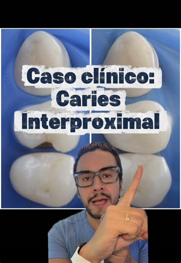 CASO CLÍNICO: Caries Interproximal 🦷 #rrdentalgdl #dentistazapopan #caries #salud #sonrisa