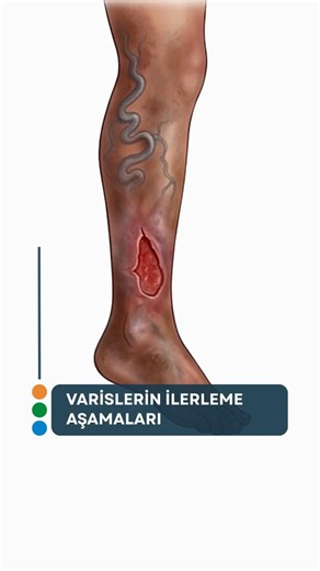 VARİSLERİN İLERLEME AŞAMASI NASILDIR? #varis #varistedavisi