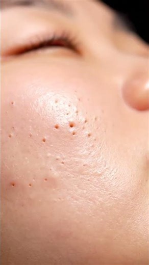 Blackhead Extraction Therapy — Smooth