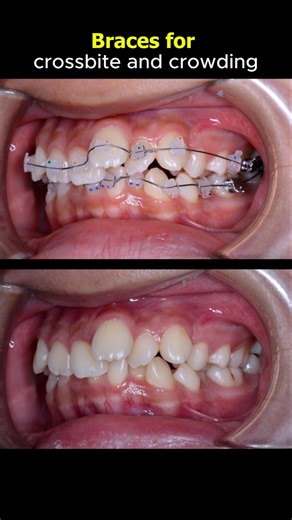 Amazing braces, change your smile journey. Don't worry if your teeth are crooked #braces #dentist