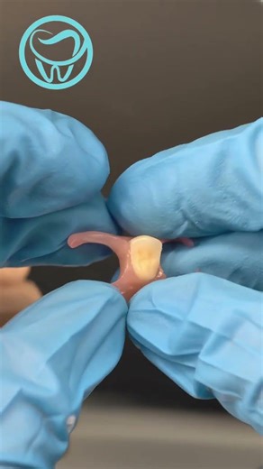 Implant-Assisted Valplast Denture Restoration #dentallab #dentist