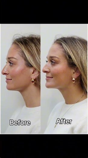 POV: getting chin filler for the first time