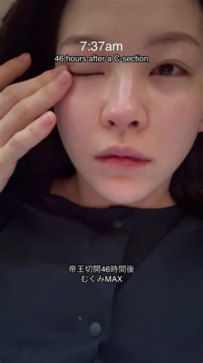 帝王切開46時間後 むくみMAX うんち💩出そう作戦です🔥 ご飯は和食を選んでビタミンも多めに摂取🍋 MVPアイテムは ブルブルローラー😘 46 hours after a C-section. Swelling at its MAX 😮‍💨 Starting my “let’s get 💩 out” mission 🔥 Chose Japanese food and made sure to get plenty of vitamins 🍋 The MVP item? The vibrating roller 😘 ครบ 46 ชั่วโมงหลังผ่าคลอด อาการบวมขึ้นถึงจุดพีค 😮‍💨 เริ่มปฏิบัติการ “กระตุ้นให้ออก 💩” 🔥 เลือกทานอาหารญี่ปุ่น และเสริมวิตามินให้เพียงพอ 🍋 ไอเท็ม MVP คือ โรลเลอร์สั่นสุดเลิฟ 😘 제왕절개 후 46시간 부기 최고조 😮‍💨 💩 나오게 하는 작전 시작 🔥 일식으로 