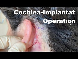 Cochlear implant surgery: Risks & consequences