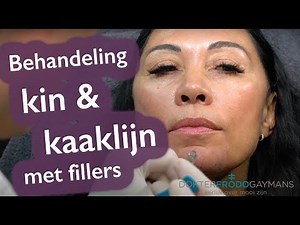 Behandeling Kaaklijn en kin met fillers/ MD codes