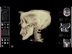 CBCT short intro to Blair Upper Cervical analysis.