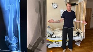 53-Year-Old Tony Hawk Breaks His Femur Skateboarding