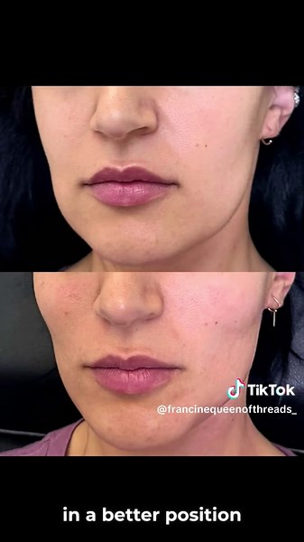 PDO Thread Lift: Achieve a Youthful Look Without Surgery