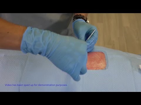 Spinal Cord Stimulator Pocket Closure with the V-Loc™ Wound Closure Device - Dr. Yeshvant Navalgund