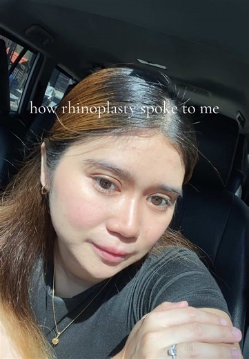 Understanding Rhinoplasty: My 2-Month Journey Post-Op