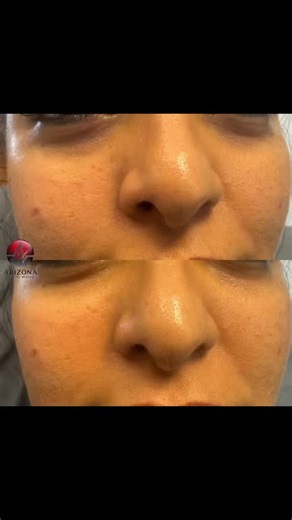 Before and after PDGF to the tear troughs — this treatment uses your body’s own growth factors to help improve under-eye texture, color, and fine lines. The results are very natural and refreshed — not puffy or overdone — and can last one to two years. 🧬 Subtle rejuvenation, long-lasting glow. 📍 Arizona Medical Medspa – Scottsdale 👩‍⚕️ Shuree Ohlemann, PA-C | 21 years in medical aesthetics ☎️ 480-766-0550 #scottsdalemedspa #pdgftreatment #teartrough #undereyerejuvenation #naturalresults | Ari