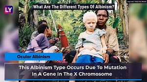 International Albinism Awareness Day 2020: Causes, Types And Diagnosis Of This Genetic Disorder - video Dailymotion