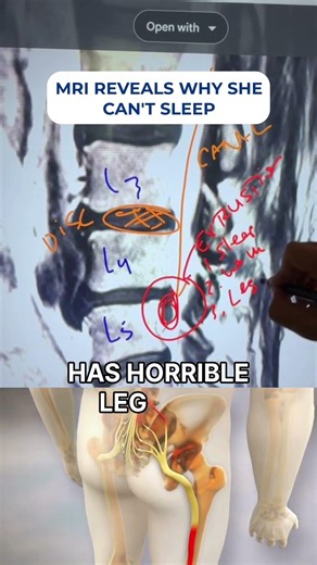 Disc extrusion at L5-L3: why it hurts and how spinal decompression helps (no surgery) #sciatica