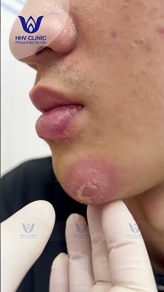Large Abscess on Chin