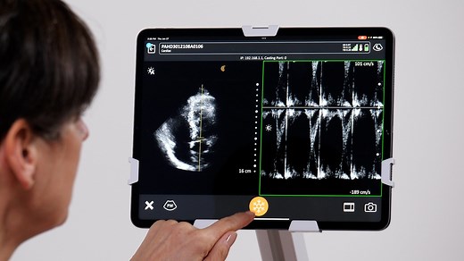 Pulsed Wave (PW) Doppler | Clarius