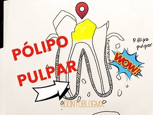 Pulpitis Hiperplásica ó Pólipo pulpar