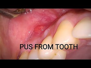 Reason for pus coming from tooth. दांत से पस निकलने के कारण