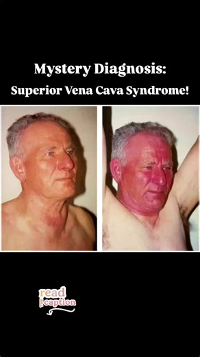 Understanding Pemberton's Sign and SVCS