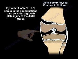 Distal Femur Physeal Fracture - Everything You Need To Know - Dr. Nabil Ebraheim • Video • MEDtube.net