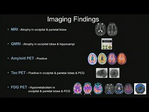 Decoding Dementia: The Lewy Body Problem