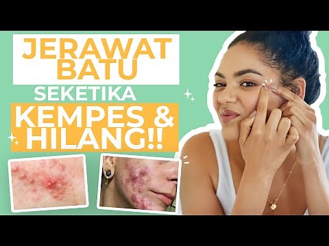 DON'T PANIC! Here are 6 Ways to Get Rid of Cystic Acne on Your Face!