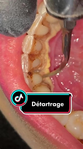 Vérifie que ton date est fait son détartrage 👀