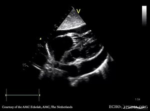 File:Pericardial effusion, "swinging heart" E00670 (CardioNetworks ECHOpedia).webm - Wikimedia Commons