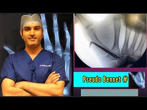 Pseudo Bennett Fracture Reduction Technique & K-Wire Fixation | 1st Metacarpal #|Thumb Fracture 🔥🔥