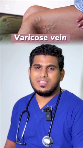 #vericoseveins #medical #healthy @Dr.Rimzan @Dr .A.N.M RIFKHAN