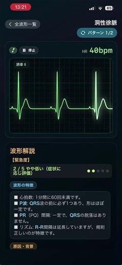 【心電図波形】 同性徐脈 #心電図#波形#同性徐脈#医療系チャンネル#shorts